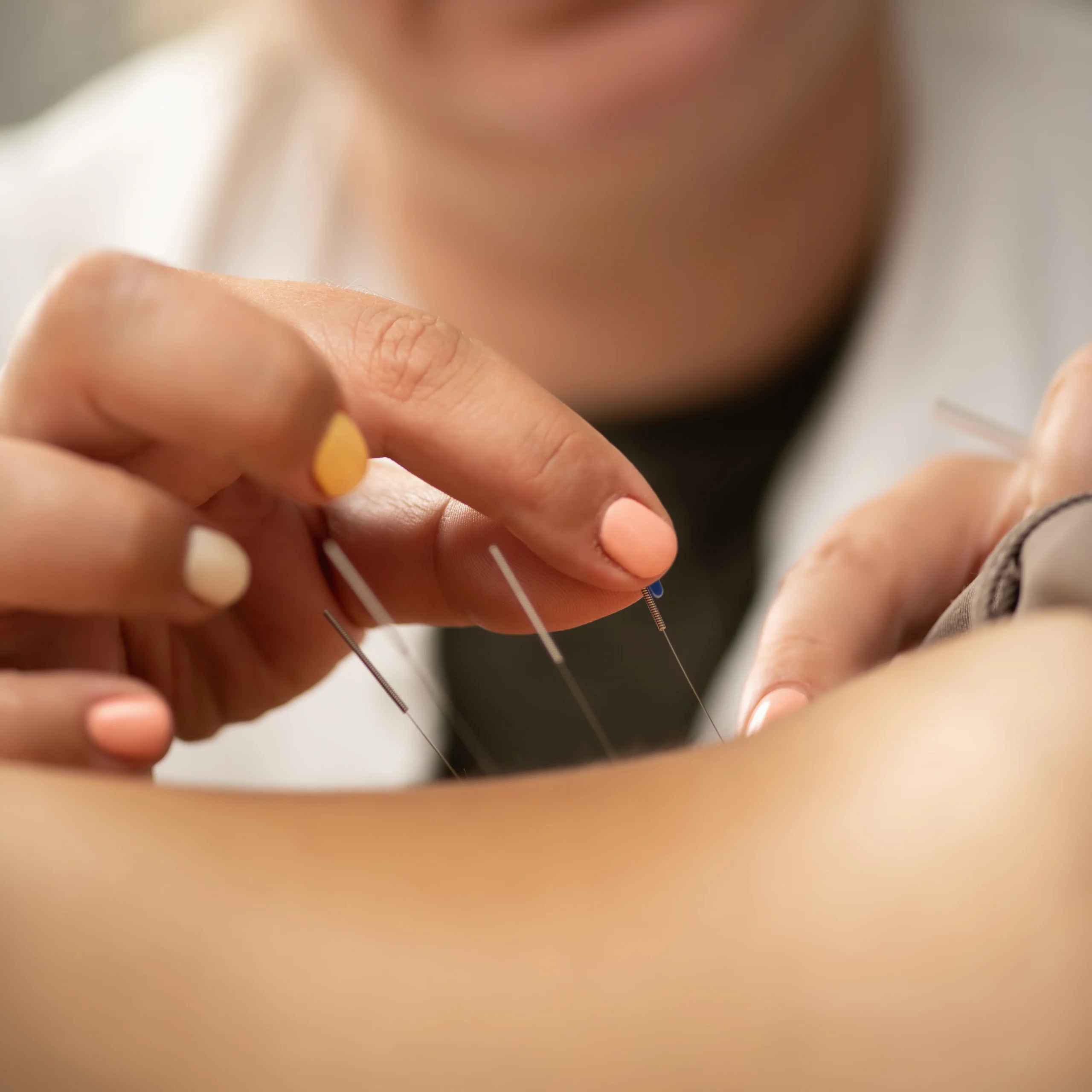 Dry Needling Calgary physiotherapist performing trigger point therapy for muscle pain