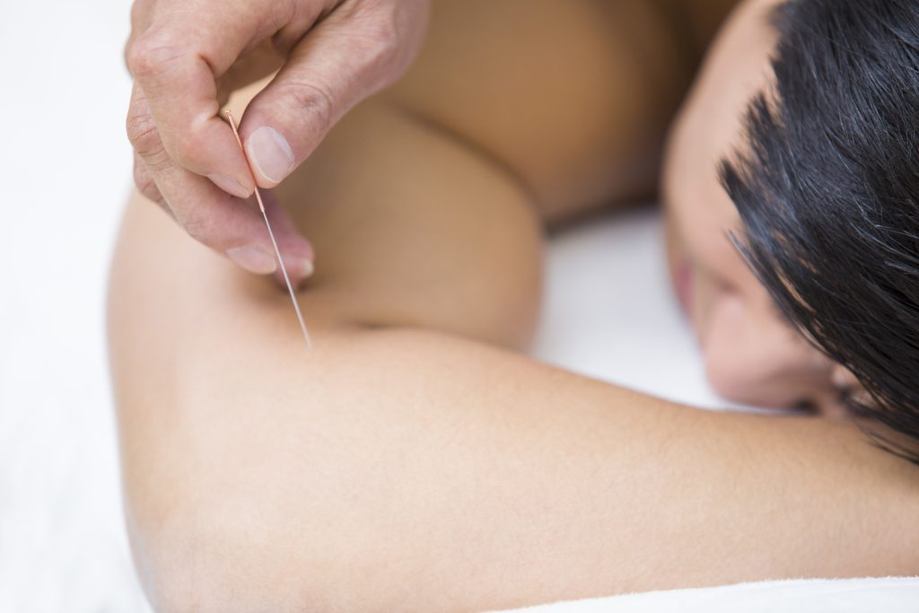 Dry Needling IMS- Everything About dry needling